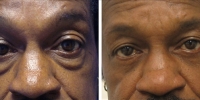 Blepharoplasty 01 / Lower Transconjunctival Blepharoplasty with Skin Pinch