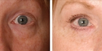 Blepharoplasty 06