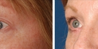 Blepharoplasty 07