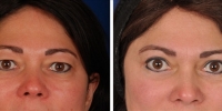 Blepharoplasty 10