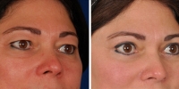 Blepharoplasty 11