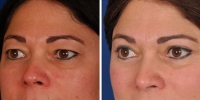 Blepharoplasty 12