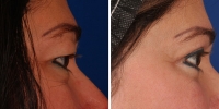 Blepharoplasty 13