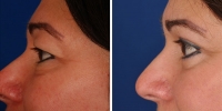 Blepharoplasty 14