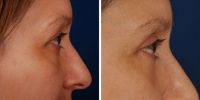 Blepharoplasty 15 / Upper and Lower Blepharoplasty