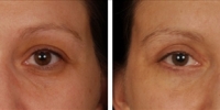 Blepharoplasty 16 / Upper and Lower Blepharoplasty