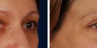 Blepharoplasty 17 / Upper and Lower Blepharoplasty