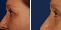 Blepharoplasty 18 / Upper and Lower Blepharoplasty