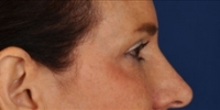 Blepharoplasty 19 / Upper Blepharoplasty