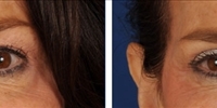 Blepharoplasty 20 / Upper Blepharoplasty