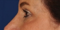 Blepharoplasty 21 / Upper Blepharoplasty