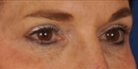 Blepharoplasty 23 / Upper Blepharoplasty