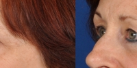 Lower Eyelid Lift Blepharoplasty Before and After Dr Edmon Khoury 106