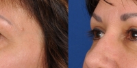 Upper Eyelid Lift Blepharoplasty Before and After Dr Edmon Khoury 101