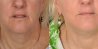 dr-khoury-facelifts-20