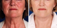 Laser Assisted Facelifts (SmartLifting) 02 / Dr. Khoury's laser assisted facelift patient before and after.