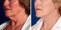 Laser Assisted Facelifts (SmartLifting) 03 / Dr. Khoury's laser assisted facelift patient before and after.