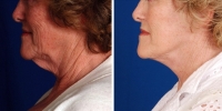 Laser Assisted Facelifts (SmartLifting) 04 /Dr. Khoury's laser assisted facelift patient before and after.