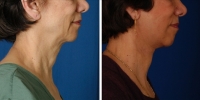 Laser Assisted Facelifts (SmartLifting) 07 / Only 7 days after SmartLifting(tm) procedure