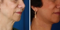 Laser Assisted Facelifts (SmartLifting) 08 / Only 7 days after SmartLifting(tm) procedure