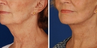 Laser Assisted Facelifts (SmartLifting) 09