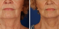 Laser Assisted Facelifts (SmartLifting) 10