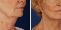 Laser Assisted Facelifts (SmartLifting) 11