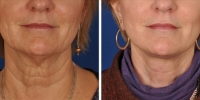 Laser Assisted Facelifts (SmartLifting) 12