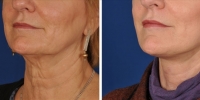 Laser Assisted Facelifts (SmartLifting) 13