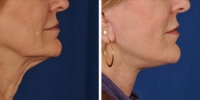 Laser Assisted Facelifts (SmartLifting) 14