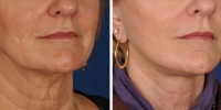 Laser Assisted Facelifts (SmartLifting) 15