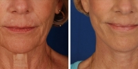 Laser Assisted Facelifts (SmartLifting) 16