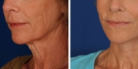 Laser Assisted Facelifts (SmartLifting) 17