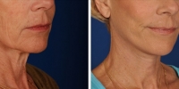 Laser Assisted Facelifts (SmartLifting) 18