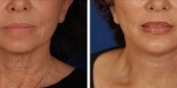 Laser Assisted Facelifts (SmartLifting) 19