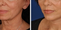 Laser Assisted Facelifts (SmartLifting) 20