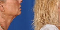 Lower Facelift Necklift Before and After Dr Edmon Khoury 104