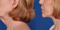 Lower Facelift Necklift Before and After Dr Edmon Khoury 116