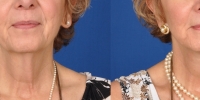 Lower Facelift Necklift Before and After Dr Edmon Khoury 117