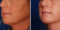 Laser Resurfacing 01