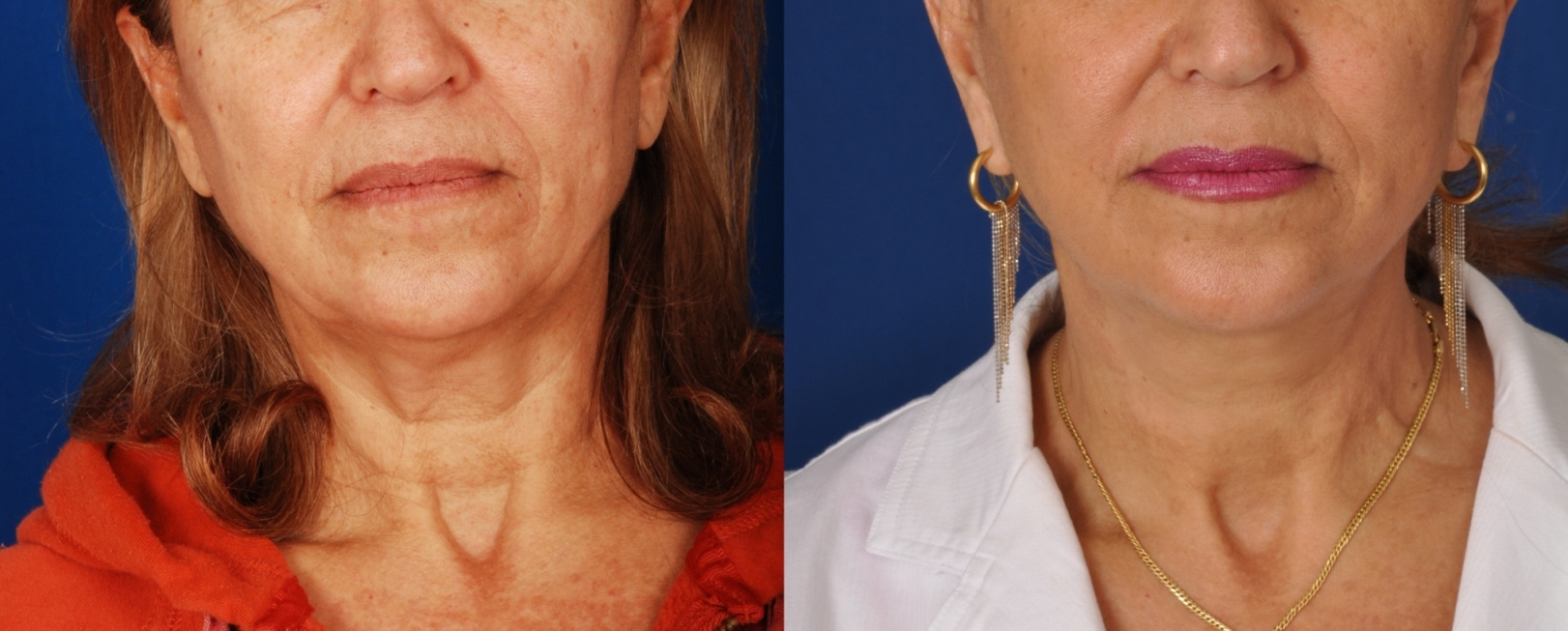 Face Lift in Denver - Patient Photo 2