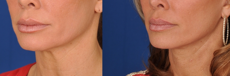 Face Lift in Denver- Patient Photo 1