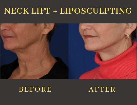 NECK LIFT + LIPOSCULPTING-img-blog