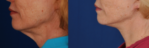 Neck Lift Before and After Photos