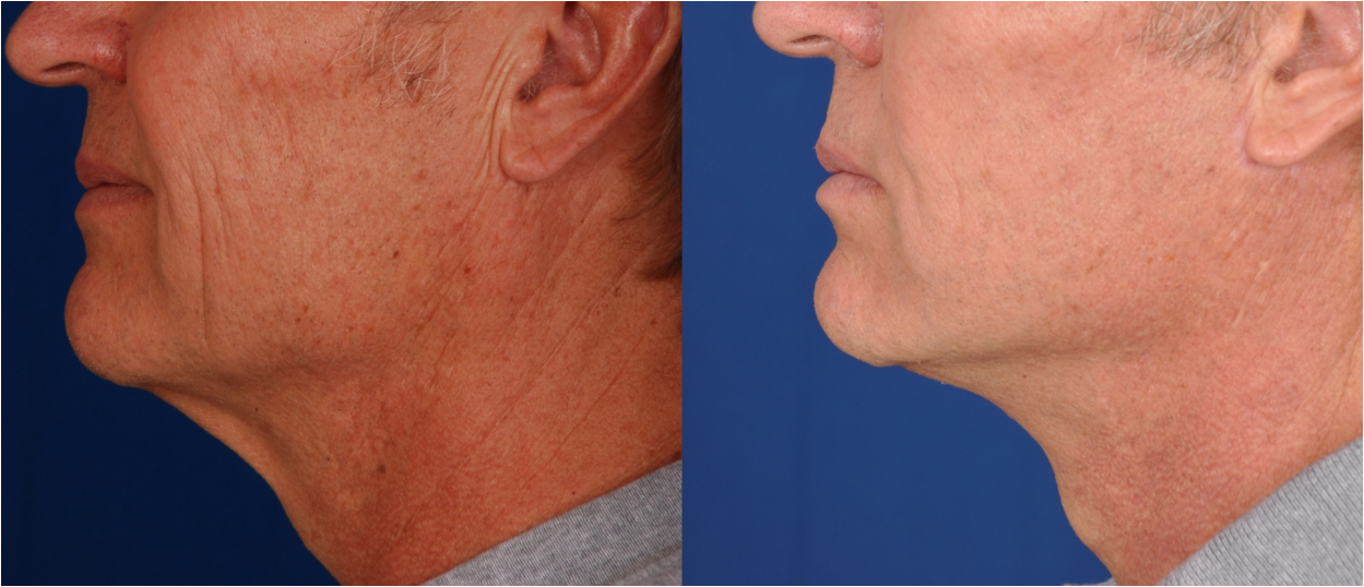 Neck Lift Before and After Photo