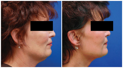 Face Lift - Patient Photo 1