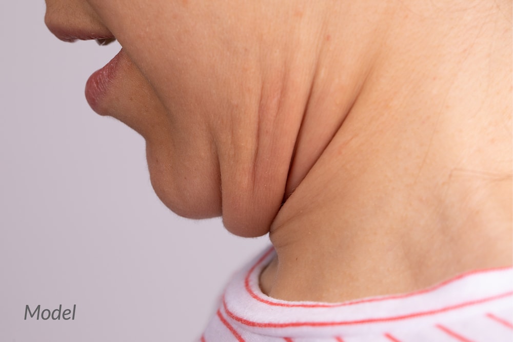 A woman seen with vertical neck bands that she will remove with a Smartlipo® procedure, which heats and liquefies fat cells.